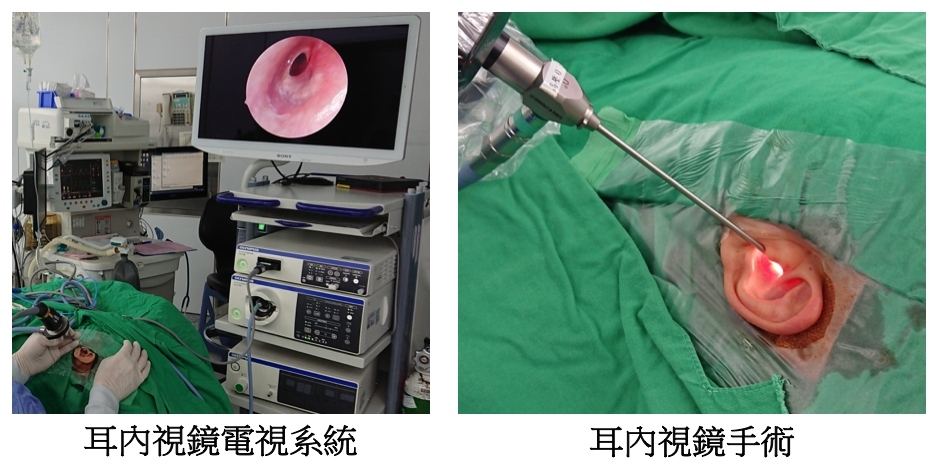 完全無傷口的中耳炎內視鏡微創手術。(記者張越安翻攝)