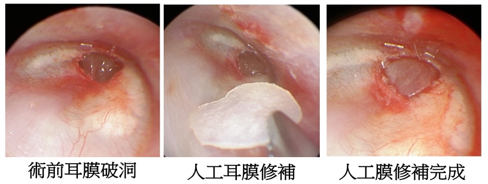 完全無傷口的中耳炎內視鏡微創手術。(記者張越安翻攝)