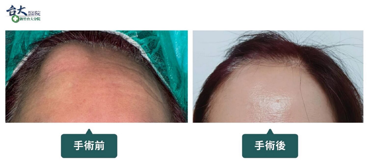 額頭或臉部有異常硬塊　醫：不論是否伴隨疼痛，都應盡早就醫！