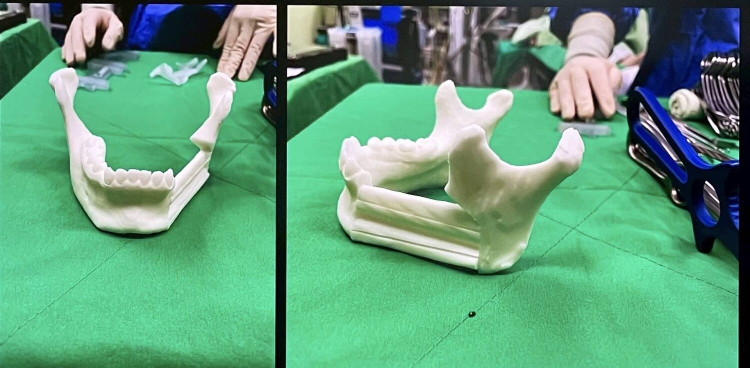 18歲少女罹患罕見顎骨腫瘤 彰化秀傳3D列印重建手術助重拾笑容