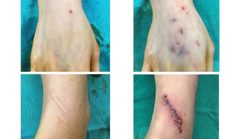 雙手刀疤累累50公分！白疤之父曹賜斌助英國港女揮別夢魘