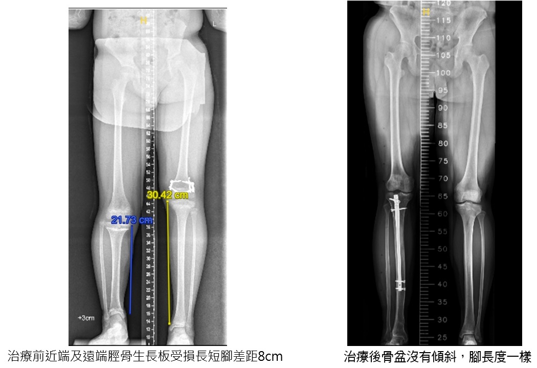 兩度骨延長16公分！嘉基環形外固定器骨助少年走向自信人生