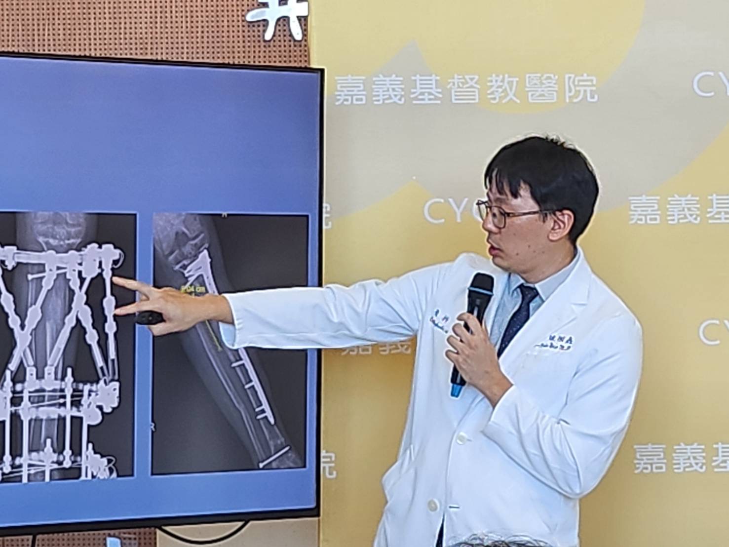 兩度骨延長16公分!嘉基環形外固定器骨助少年走向自信人生 兩度骨延長16公分!嘉基環形外固定器骨助少年走向自信人生